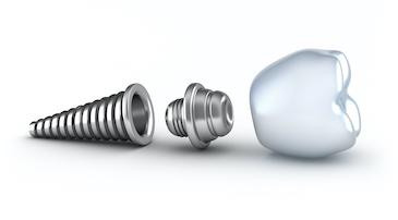 dental implant in dunedin