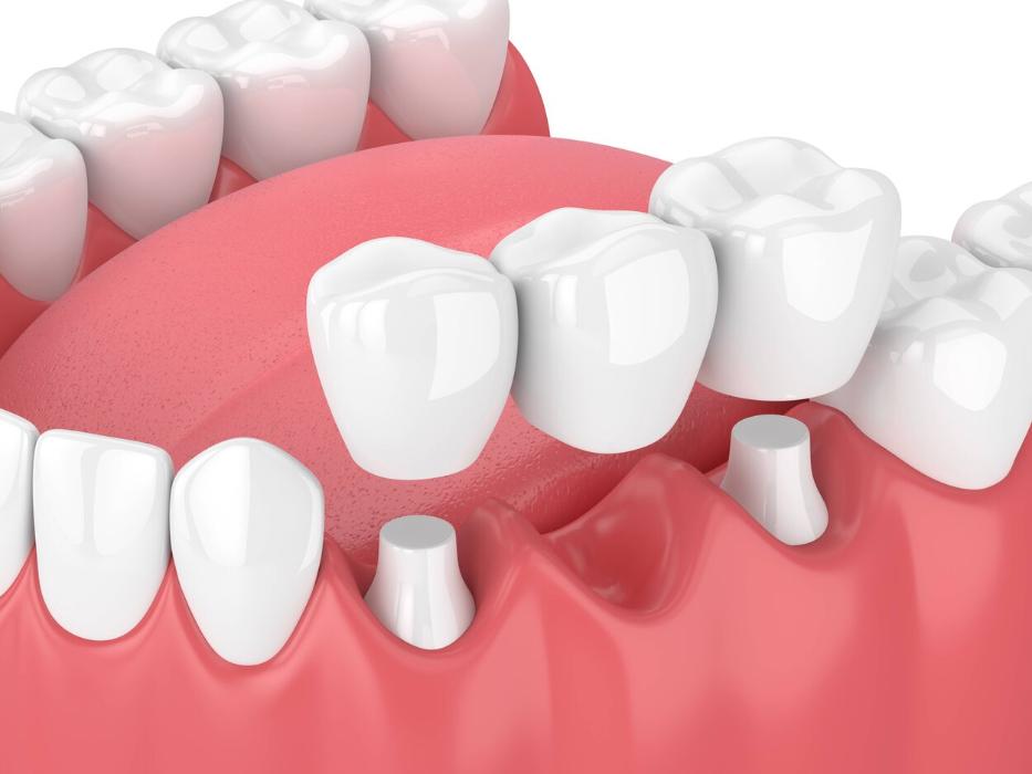 dental bridges dunedin