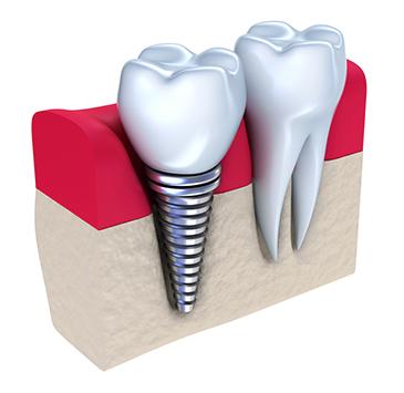 Diagram of dental implants in Dunedin