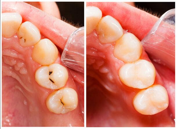 teeth before and after a filling