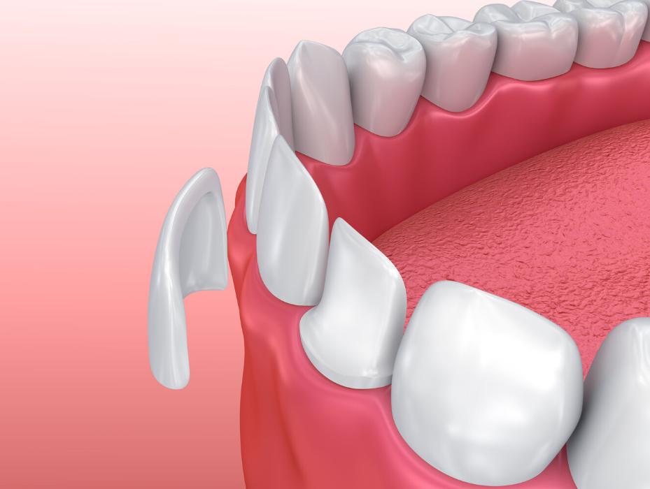 dental veneers in dunedin