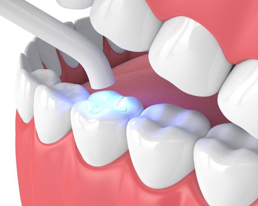 white dental fillings
