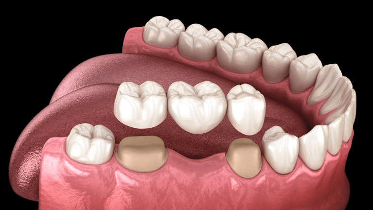 Diagram of dental bridge in Dunedin, Otago