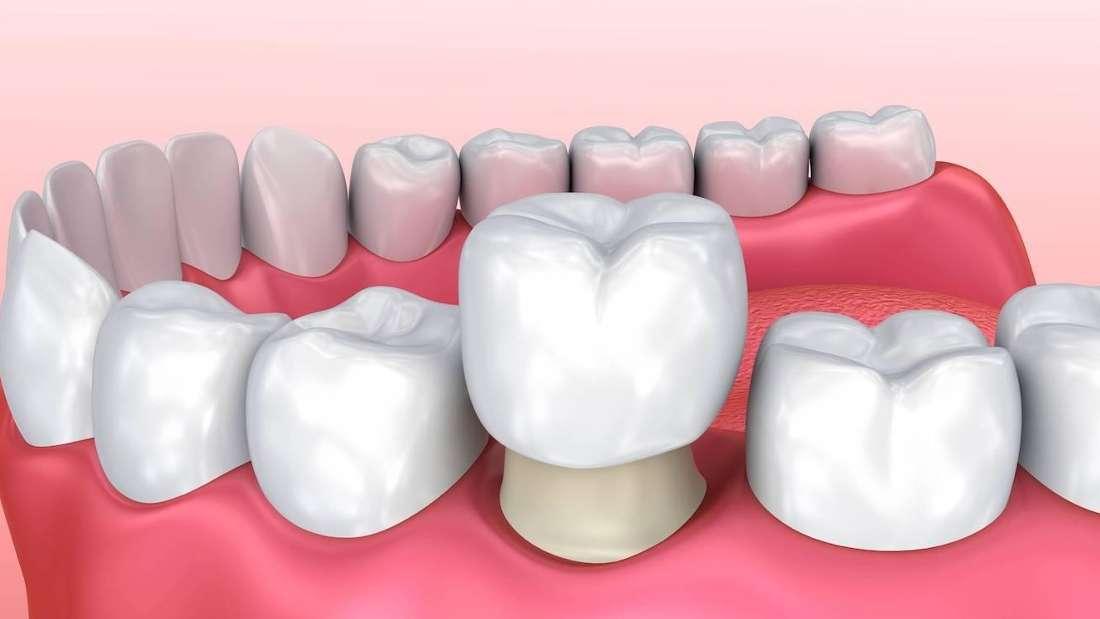 Dunedin NZ Dental Crowns Blog Why You Need Crowns on Teeth